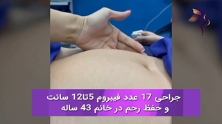 حفظ رحم با وجود 17 عدد فیبروم