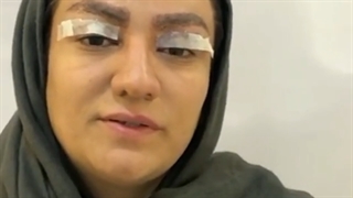 بلفاروپلاستی پلک بالا جهت برطرف کردن پف بالای پلک