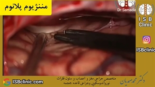 مننژیوم پلانوم