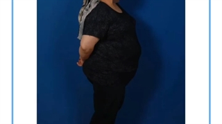 تصاویر قبل و بعد از عمل چاقی