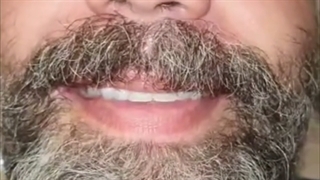 لمینت دندان