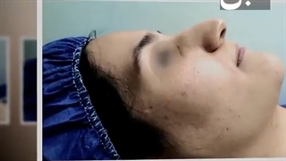 فیلم واقعی عمل جراحی بینی