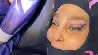 بلفاروپلاستی یا جراحی پلک