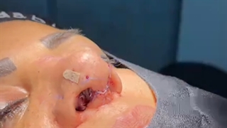 لایو جراحی بینی ترمیمی