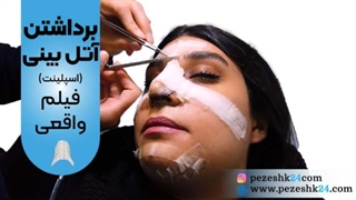 فیلم برداشتن اسپلینت بینی (آتل بینی) توسط دکتر اکبریان