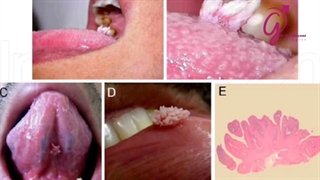 زگیل تناسلی در دهان