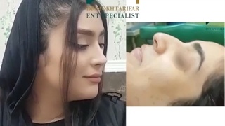 جراحی بینی پس از شش ماه