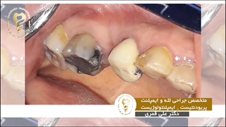 جراحی ایمپلنت 3 دندان در فک پایین و 1 دندان در فک بالا