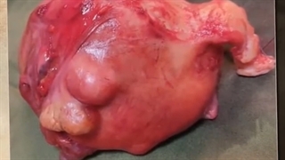 فیلم خارج کردن رحم و تخمدان