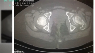 لغزش اپی فیز فمور