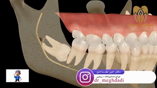 فیلم جراحی دندان عقل