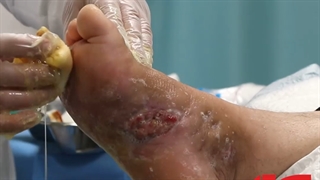 پانسمان زخم با کلاژن