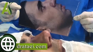 جراحی بینی مردانه