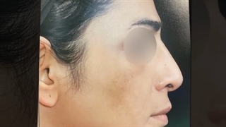 جراحی زیبایی بینی