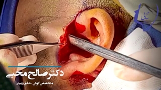 فیلم پیوند عصب قطع شده صورت