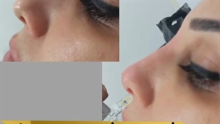 رفع عیوب بینی توسط فیلر