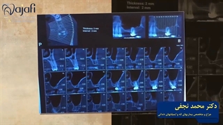 جراحی سینوس لیفت اپن