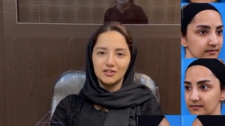 رضایت از عمل بینی گوشتی