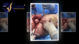 جراحی تعویض مفصل کامل لگن خانم 49 ساله