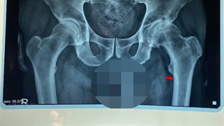 فیلم واقعی جراحی تعویض مفصل لگن
