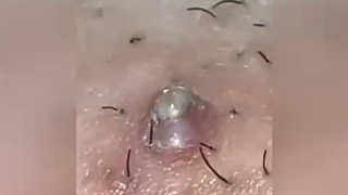 خارج کردن جوش