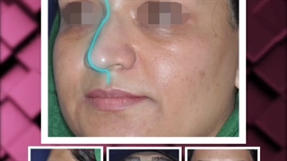 عمل بینی گوشتی