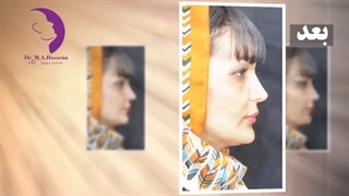 جراحی بینی نمیه گوشتی توسط دکتر محمدعلی حسینی