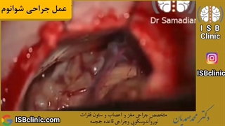 عمل جراحی شوانوم سی پی انگل