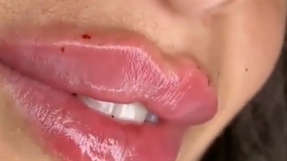 تزریق ژل لب روسی