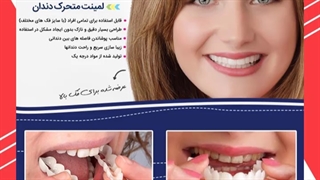 خرید لمینت متحرک دندان