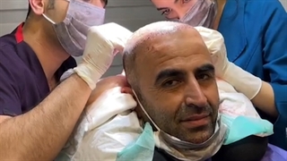 مراحل کاشت مو