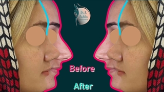نمونه قبل و بعد از عمل بینی
