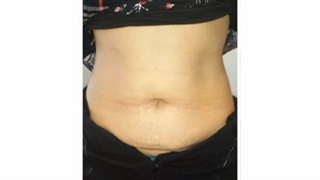 لاغری با دستگاه LDM