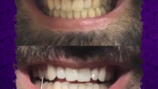 بلیچینگ دندان