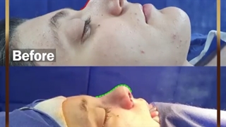 جراحی زیبایی بینی توسط دکتر طاهریان