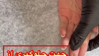 بوتاکس کف دست