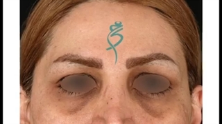 تزریق چربی زیر چشم