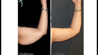 جراحی براکیو پلاستی یا لیفت بازو