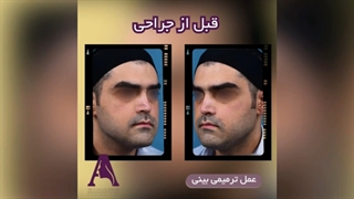 بعد از عمل ترمیمی بینی