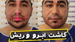 کاشت ریش ابرو در یک جلسه در کلینیک vip
