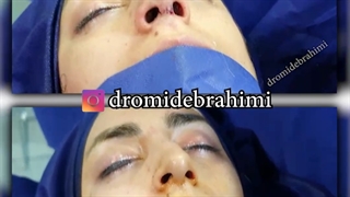 عمل زیبایی بینی | دکتر ابراهیمی