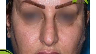 جراحی زیبایی بینی گوشتی