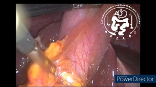 رسیدن به نمای امن در کله سیستکتومی لاپاروسکوپیک