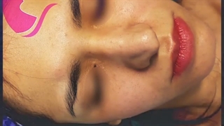 جراحی زیبایی بینی ثانویه