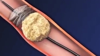 شکستن سنگ کلیه