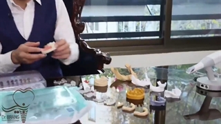 درمان ایمپلنت عادی
