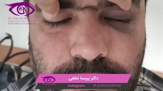 شکستگی کف اربیت