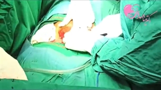 موضوع: جراحى سزارین بخش دوم