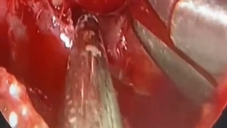 عمل جراحی اندوسکوپیک تومور آدنومای هیپوفیز