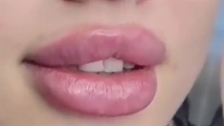 فیلم تزریق ژل به لب